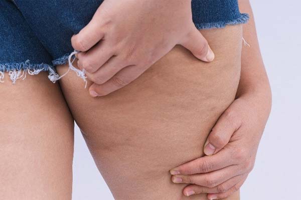 Coincé avec de la cellulite ? Regardez simplement ces conseils !